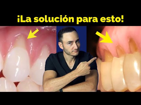 Gum recession and wear at the neck of the teeth: How is it solved and what causes it?