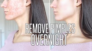 How To Get Rid Of Pimples OVERNIGHT
