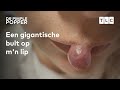 Hoe komt Angelica aan deze bult op haar lip?