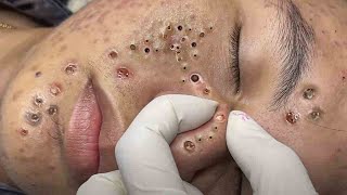 Extreme Blackhead Removal Skincare #373