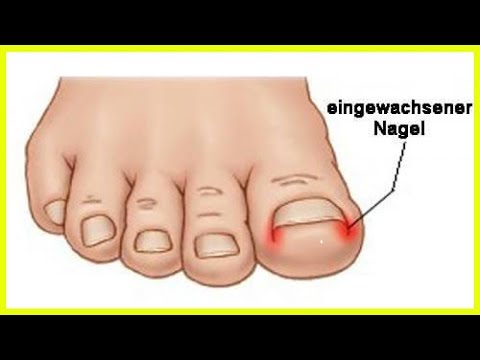 Welche Pillen in Typ-2-Diabetes nach 55 Jahren in Anspruch nehmen Risiko der Entwicklung von Diabetes