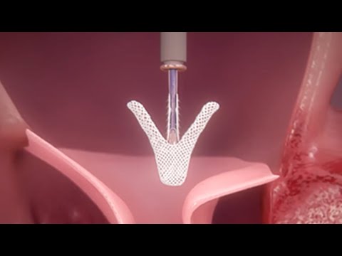 Minimally-Invasive MitraClip™ Therapy: How Does It Work?
