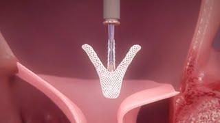 Minimally-Invasive MitraClip™ Therapy: How Does It Work