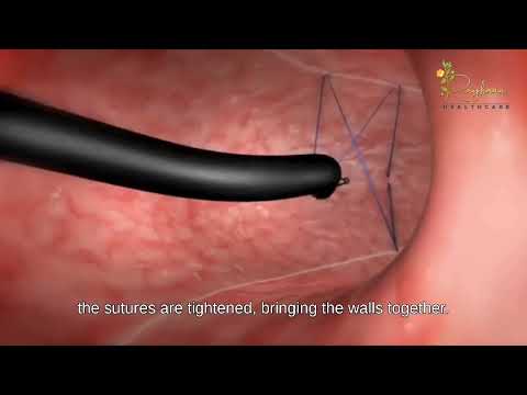 Endoscopic Gastric Sleeve Video