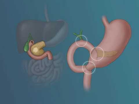 Management of Pancreatic Cancer with Whipple procedure - Video Series