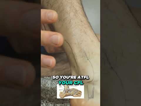 Why Is My Sprained Ankle Still Swollen After 3 6 or 12 MONTHS