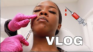 I GOT FILLERS FOR THE FIRST TIME!! GOODBYE SMILE LINES| NASOLABIAL FOLDS FILLERS