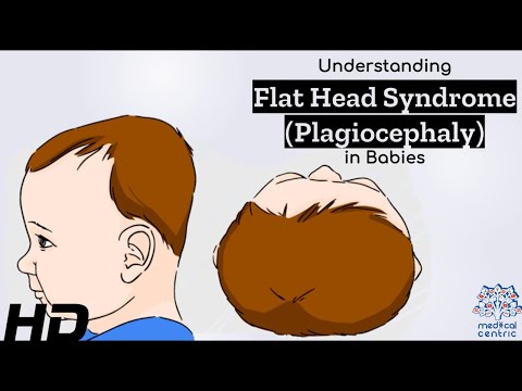 Flat Head Syndrome Explained: Causes, Symptoms, and Solutions