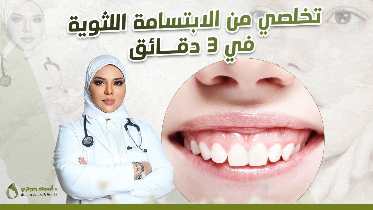 تجميل الابتسامة اللثوية بدون عمليات أو جراحة | شوفي النتيجة قبل وبعد