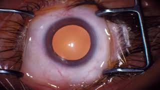 Cirugía de corrección de la Presbicia con Lente intra ocular