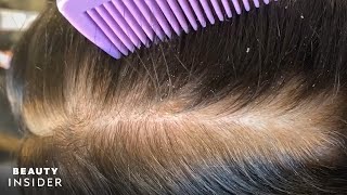 How Severe Dandruff Is Removed From The Scalp | Insider Beauty