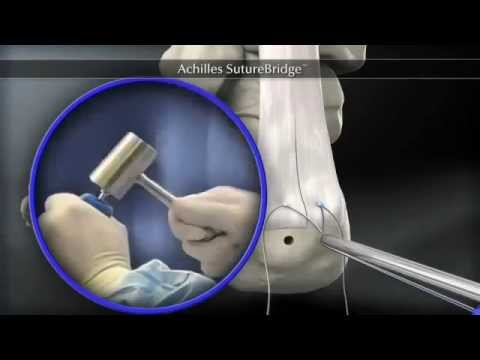 Osteocondrosi punto sanguisuga Articolazioni masturbazione