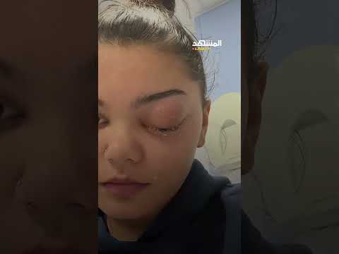 من بردٍ خفيف إلى كارثة!.. زكام بسيط ينتهي بجراحةٍ استمرت 9 ساعات لإنقاذ عين فتاة بريطانية!