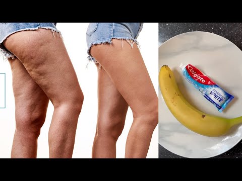 , title : 'natural cure for varicose veins with banana peel / home treatment for varicose veins in 5 days'