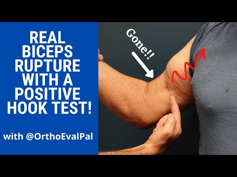 Hook Test For Distal Biceps Rupture