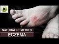 Skin Care - Eczema - Natural Ayurvedic Home ...