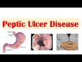 Peptic Ulcer Disease (Gastric vs. Duodenal Ulcers) | Causes,  Symptoms, Diagnosis, Treatment