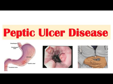 Irritable Bowel Syndrome IBS Causes Symptoms Bristol Stool Chart Types and Treatment