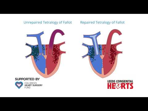 Tetralogy of Fallot: Initial repairs