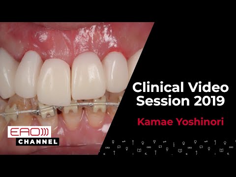 Pontic guided flapless surgery