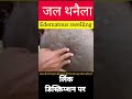 Edematous Swelling L Dr Umar Khan L Https Youtu Be P5CDjS HpFg