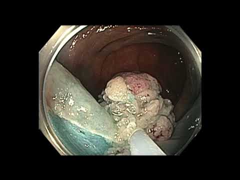 Colonoscopia - colon transverso - resección de pólipo grande