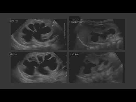 Proactive management of posterior urethral valves  (PUV)