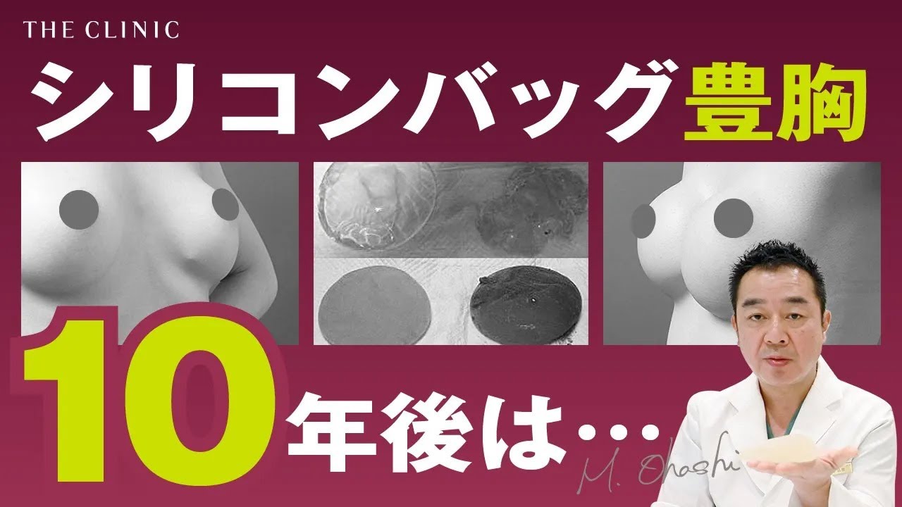シリコンバッグ豊胸の10年後のリアル|リスクと対策を徹底解説