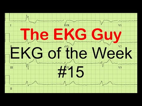 EKG/ECG of the Week #15 | The EKG Guy - www.ekg.md