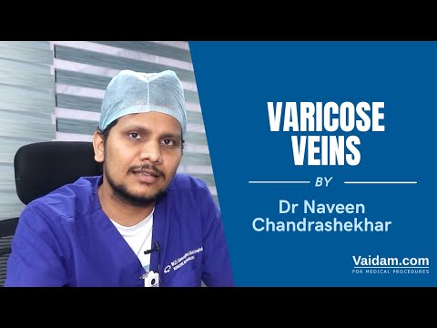 Varicose Veins Best Explained By Dr. Naveen Chandrashekhar
