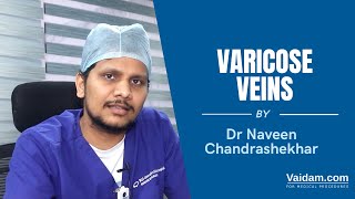 Varicose Veins Best Explained By Dr. Naveen Chandrashekhar