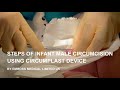 Infant Male Circumcision With Circumplast Device Best Ring