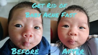 How to Get Rid of Baby Acne Fast