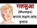 गलसुआ (mumps, कनफेड, कण्ठमाला का रोग ) क्या है, क्यो
