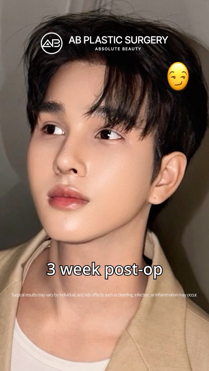 Rhinoplasty Changed His Look