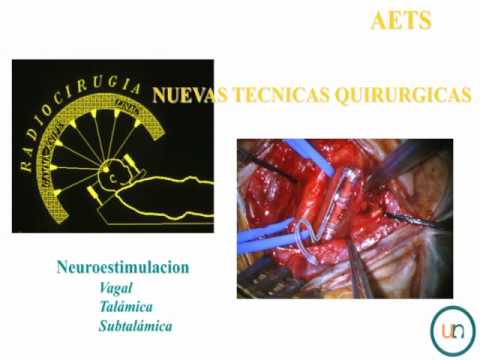 Cirugía de la Epilepsia - Día Nacional de la Epilepsia - APADE 2011