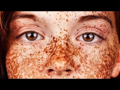 Сильное средство от пигментных пятен на лице Как закрасить пигментные пятна