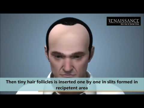 HAIR TRANSPLANT TECHNIQUE
