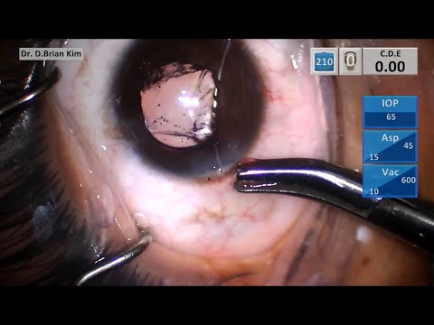 Secondary IOL With Pupilloplasty 