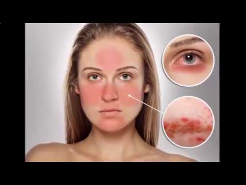 Tratamento de psoríase levomekoly Atopic dermatite infantil