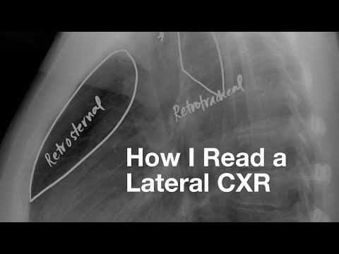 How I Read a Lateral CXR
