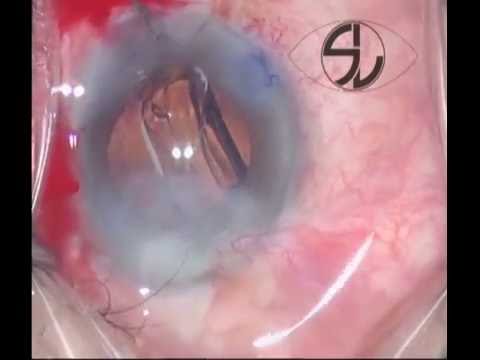 Cirugía de cataratas con leucoma corneal