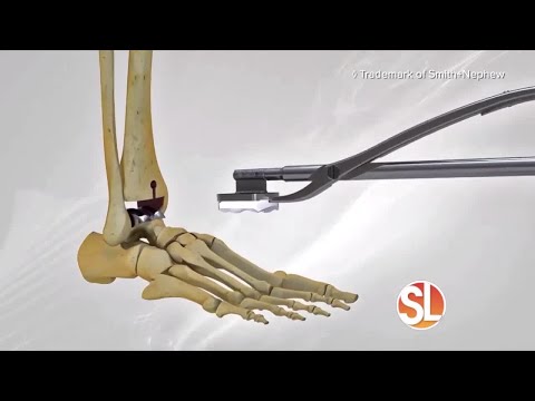 Phoenix Foot and Ankle Institute explains how they do a total ankle replacement for ankle arthritis
