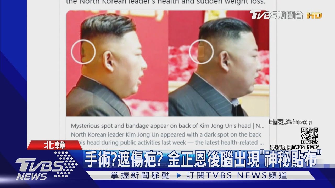 手術?遮傷疤? 韓媒:金正恩後腦出現「神秘貼布」
