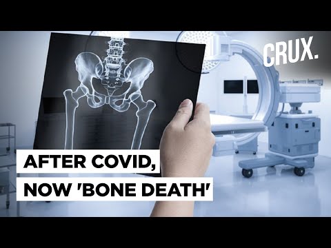 After Black Fungus, now ‘Bone Death’ Scare Emerges: New Post Covid Complication Explained