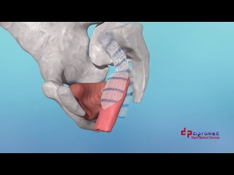 HAlbamesh - Mesh for Colposacropexy