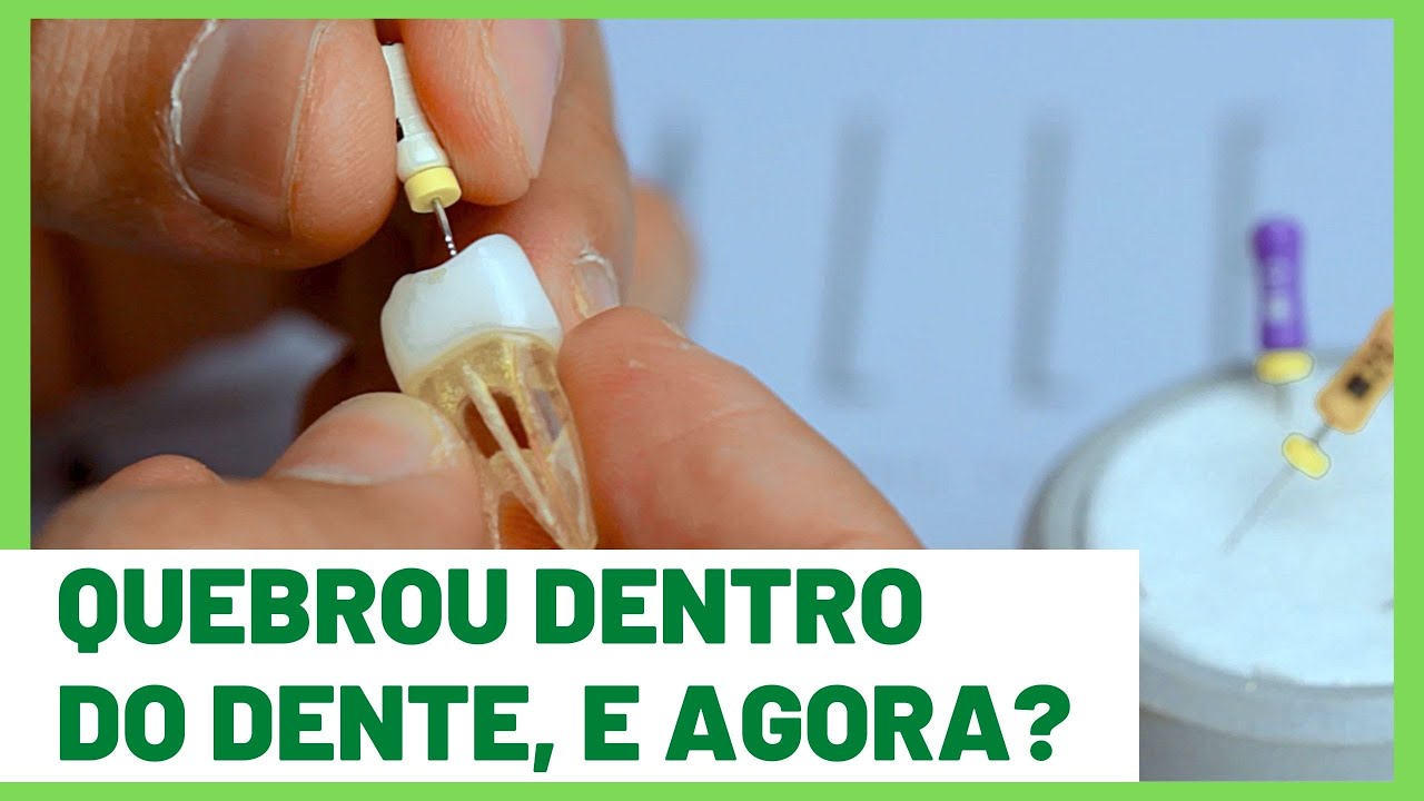A LIMA QUEBROU DENTRO DO CANAL, E AGORA? DR. FERNANDO CARNEIRO