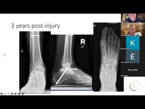 Talus fractures - the open injury  👹