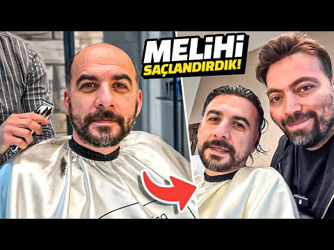WE MADE A HAIR PROSTHESIS FOR MELIH! @MelihAbuafLA