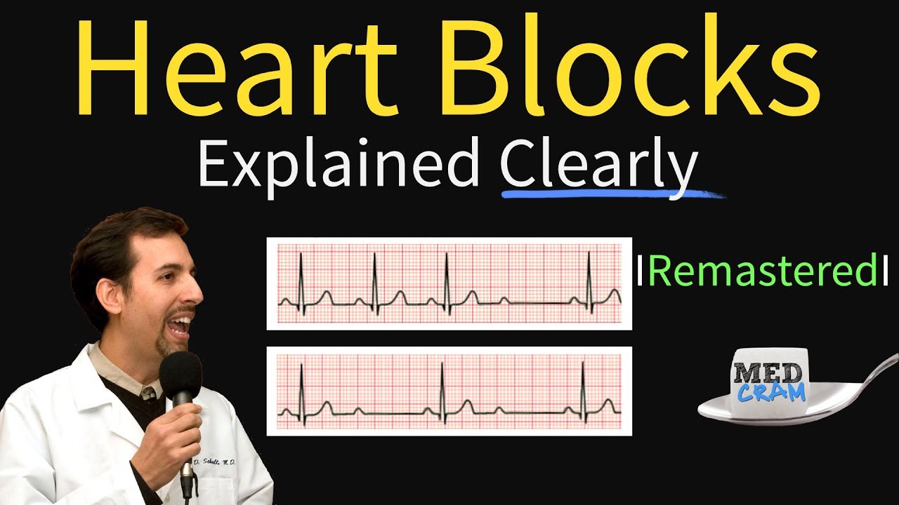 Heart Blocks Explained - First, Second, Third Degree and Bundle Branch on ECG